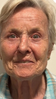 Vorher-Nachher-Ergebnis einer Wonder-Visage-Behandlung im Profil