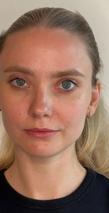 Vorher-Nachher-Ergebnis einer Wonder-Visage-Behandlung im Gesicht